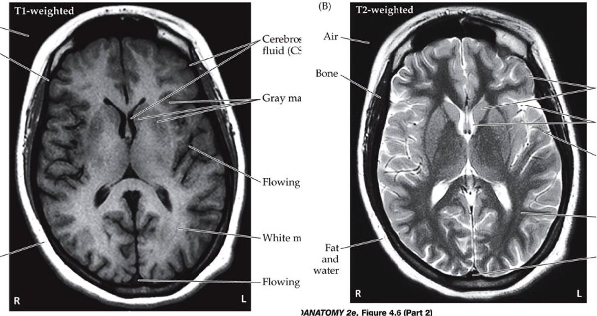 HartSakai's tweet photo. Tips to differentiate between MRI T1 and T2! 
🧠T1:  looks like a wet brain, grey matter &amp; CSF is dark, bone is black!
🧠T2: looks like a negative, CSF is bright, white matter is dark!
#PT546Week7 #neuropathology @juliehershberg https://t.co/PdE9Q8jYhY