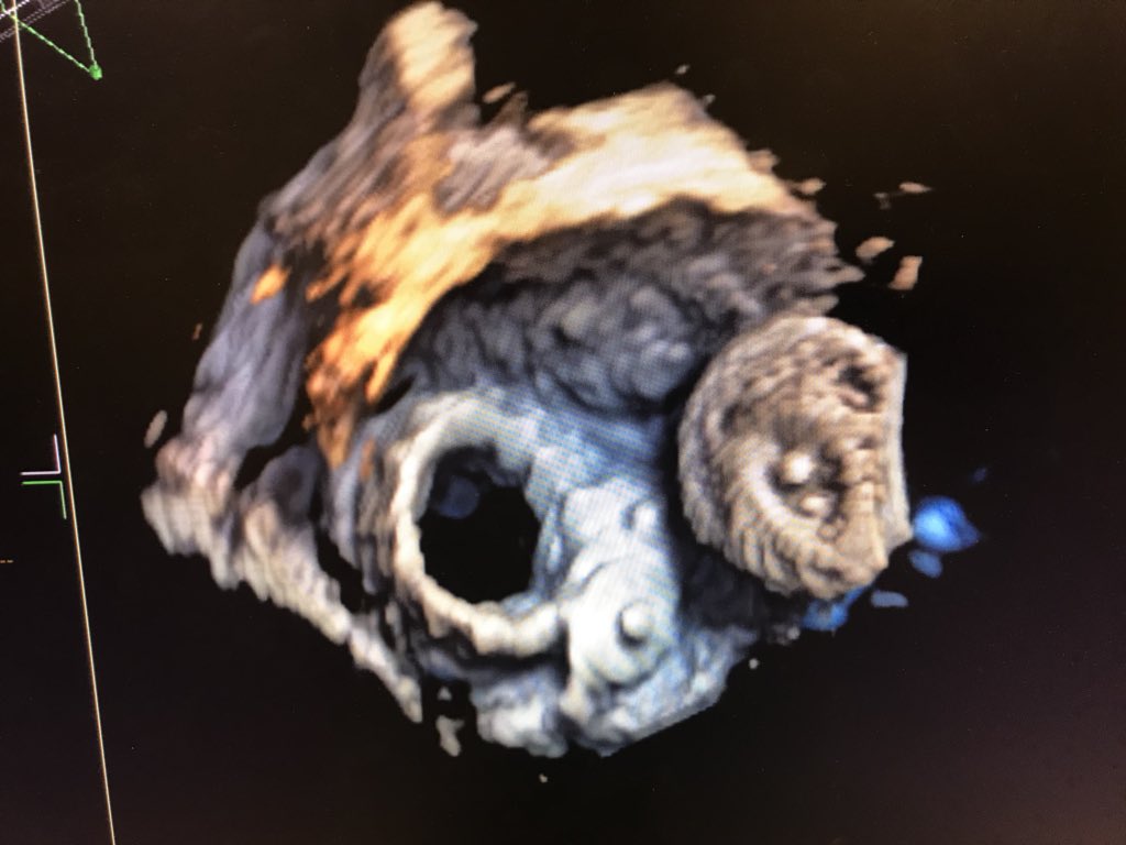 JamesDThomasMD1's tweet photo. Just another day in the Northwestern Cath Lab: that's a TAVR in a mitral ring, two plugs for paravalvular leak medial, and an Amplatzer to close the septum! #northwesternmed #BCVI https://t.co/n0NXoCajKh