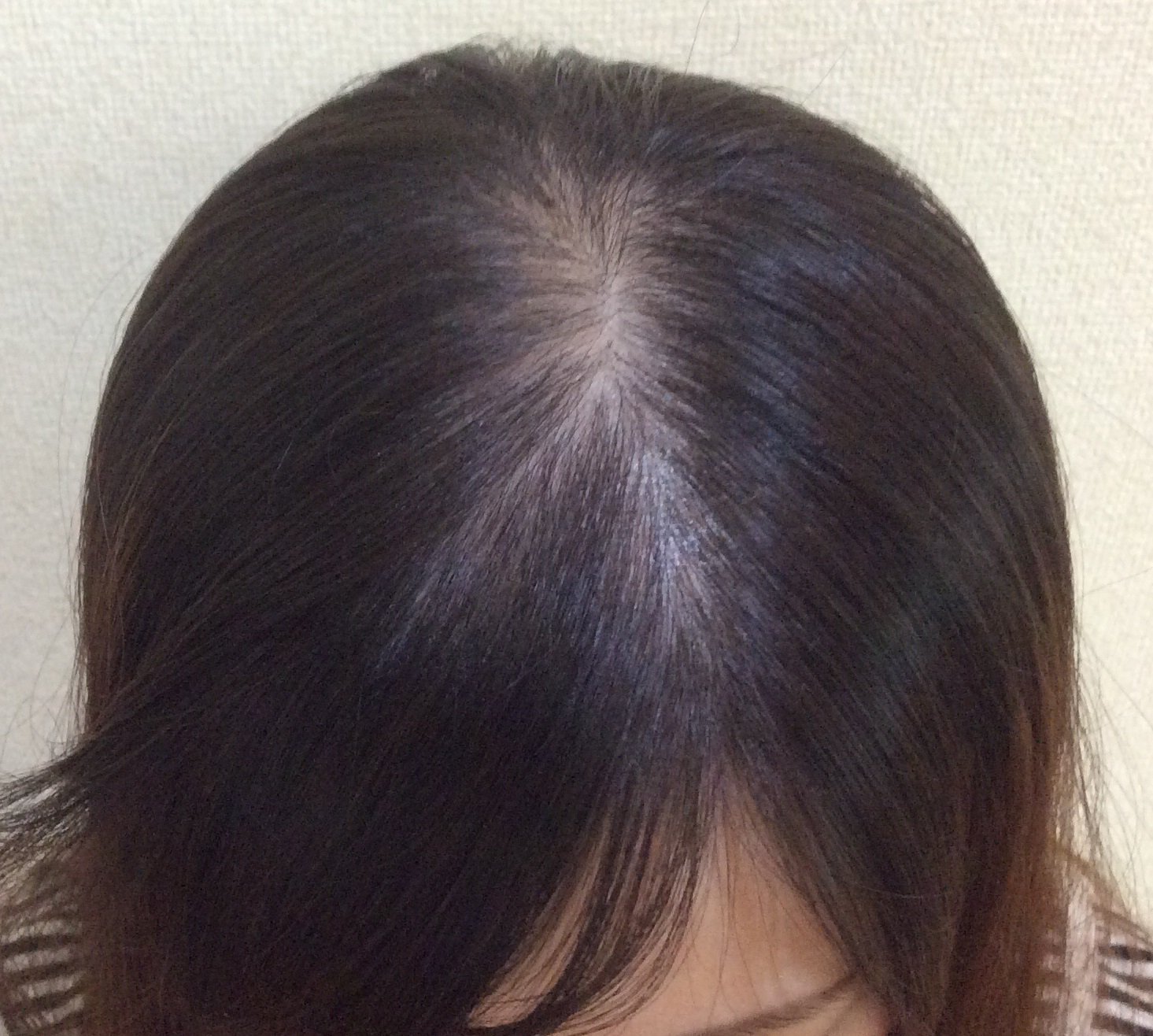 広島発毛・AGA・薄毛治療専門DANTE on Twitter "スーパースカルプでは、女性の薄毛についても対応可能となっております。 薄毛