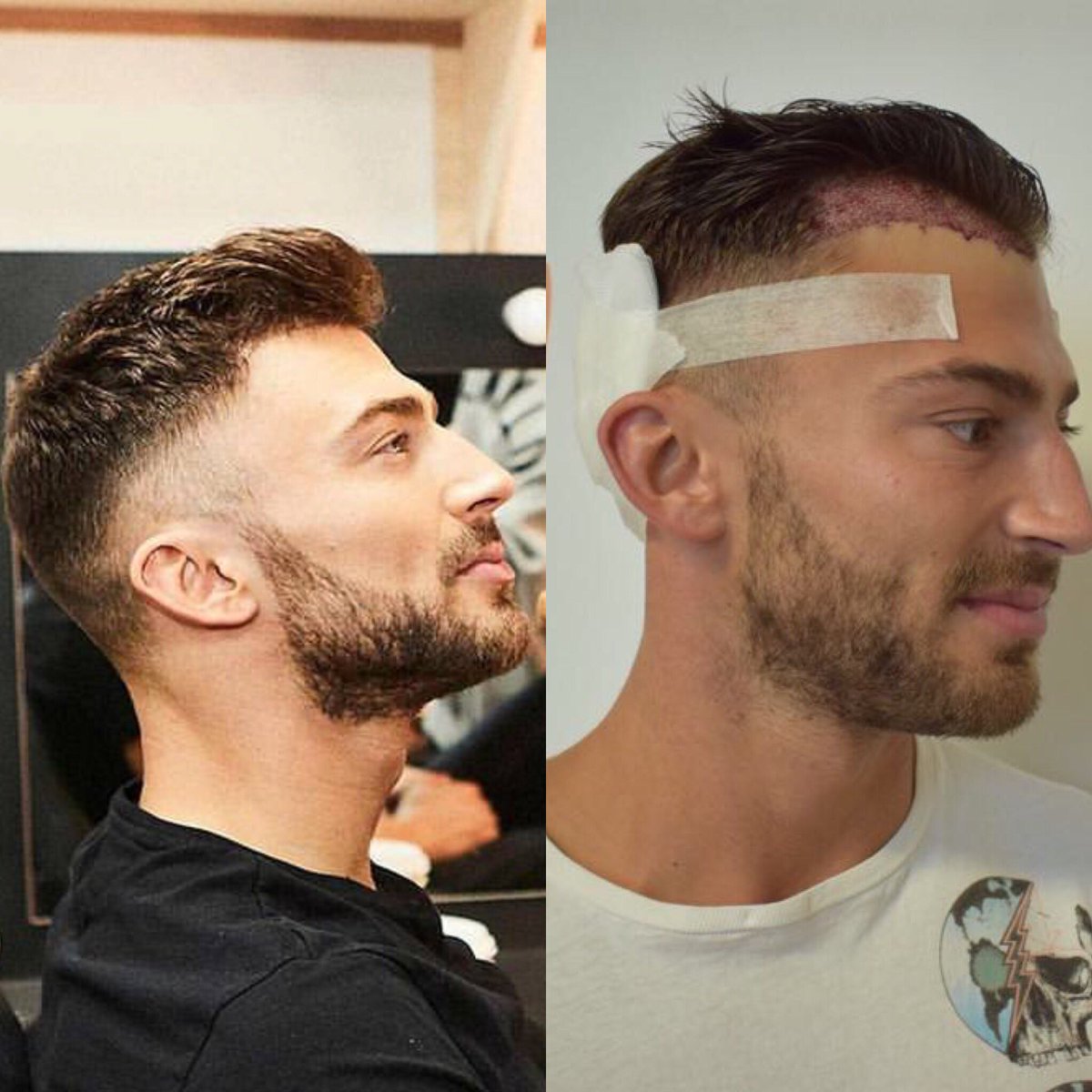 Ksl Clinics Hair Transplant Experts On Twitter Wow How Good Does Jakequickenden Hair Look Keep Up The Good Work Jake Kingoftheice Kslukno1 Dancingonice Jaketowin Https T Co Hfr0jejtgs Twitter