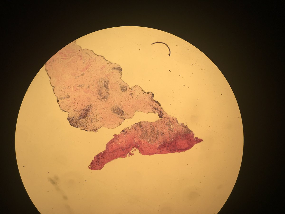 DukeMardukas's tweet photo. #brstpath #pathology thought I would join in on the fun and share. Nipple punch biopsy 60 y.o. https://t.co/fr6Rkjft2n