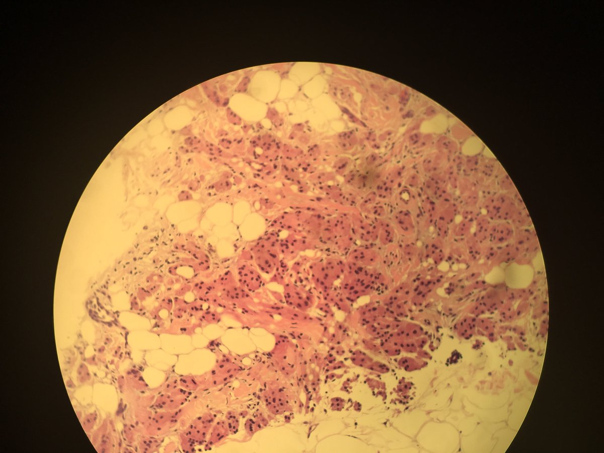 DukeMardukas's tweet photo. #brstpath #pathology one more. breast mass 33 y.o. https://t.co/cREDPXMagF