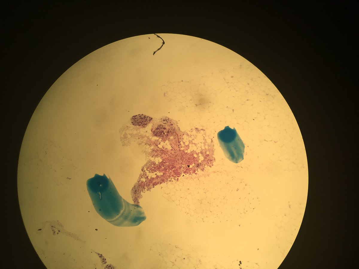 DukeMardukas's tweet photo. #brstpath #pathology one more. breast mass 33 y.o. https://t.co/cREDPXMagF