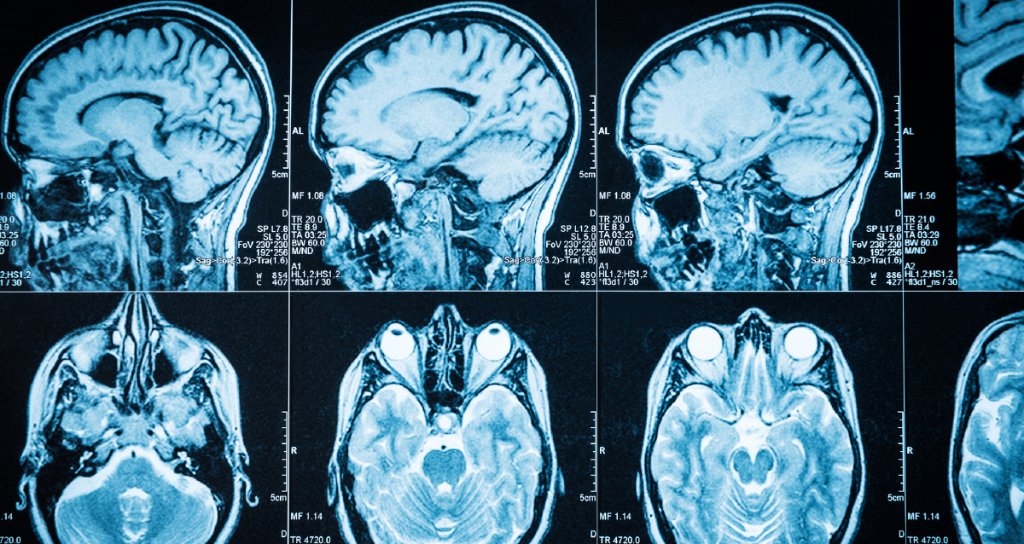 WebMD's tweet image. Many conditions or health problems can cause sudden confusion, and some are more serious than others. What you need to know: wb.md/2C1U6Kj