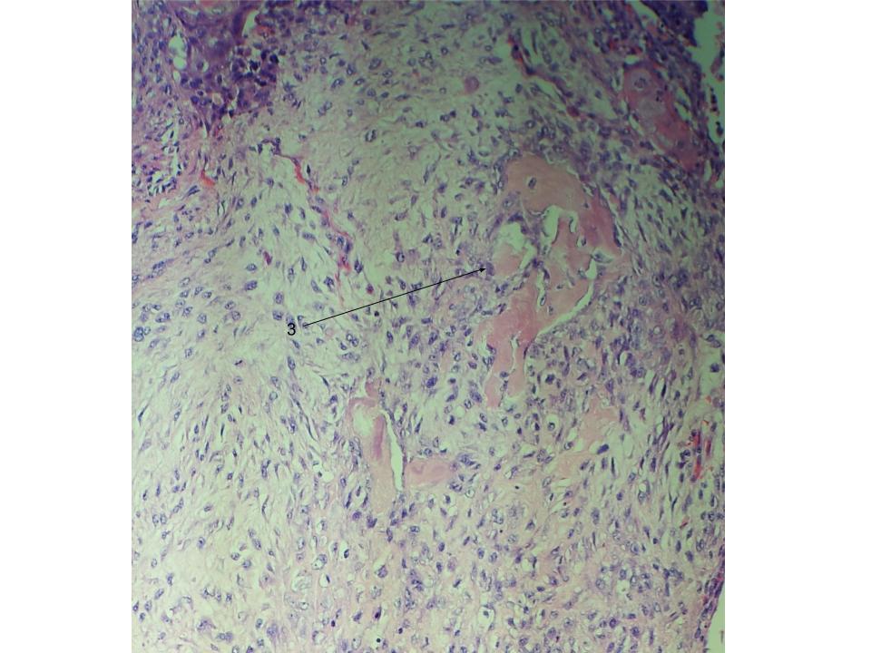 Ho_Khanh_MD's tweet photo. Uterus : Malignant Mixed Müllerian Tumor - carcinosarcoma. Biphasic tumor with carcinomatous and sarcoma-like elements. High grade endometrioid adk (1) w/squamous morules (2) ; sarcomatous components (3) focally heterologous w/osteoid  #gynpath #pathology #pathologists https://t.co/xtmyLP8pTP