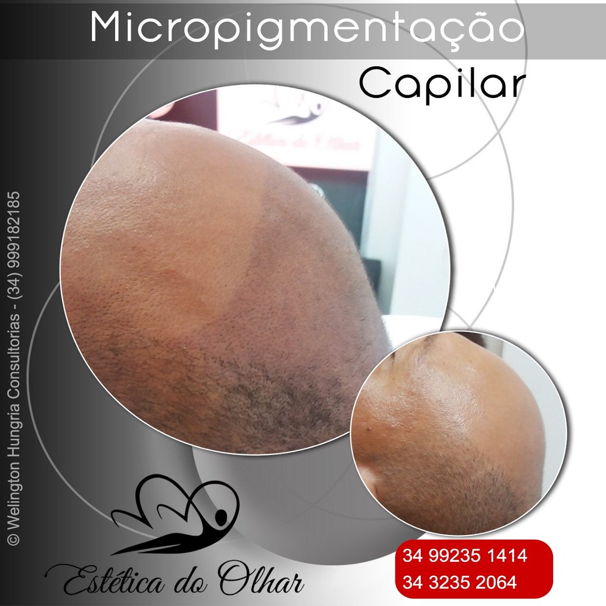 Welingtonph's tweet image. ‼*Micropigmentação Capilar* by Welington Hungria❗ 

✔Agende ainda hoje sua avaliação e de adeus a sua calvície.

✔Avaliação gratuita. 📞Whats 34 992351414 Fone 34 32352064
🏠Avenida Afonso Pena n 1982. B. Aparecida

#scalppigmentation #capilar #Micropigmentação #cabelo