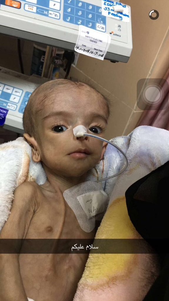 Xabd_ml1's tweet photo. خطأ طبي في مستشفى النساء والولاده بالمدينة المنورة
كان سبب في معاناتها  سنه 
تحتاج  علاج  زراعة امعاء ومستشفيات الرياض تستقبلها
نتمنى منكم مساعدتها ولو برتويت الدال ع الخير كفاعله 
وشاركونا الهاشتاق #انقذوا_همس 
ليصل اكبر عدد

هذا الرقم للتواصل مع والدها 
0537109388
#انقذوا_همس https://t.co/iebhFXCdxN