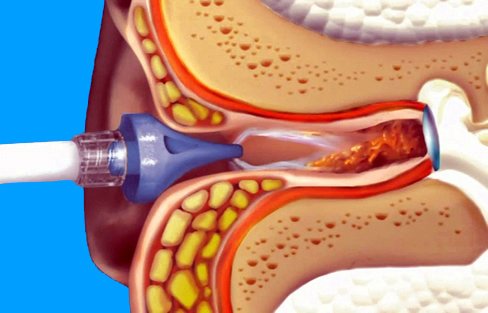 A L F On Twitter Tridal Wave Three Stream Ear Cleaning System