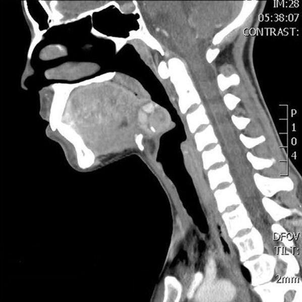 AuntMinnie.com (@auntminnie) on Twitter photo Can you solve this #radiology case from Latvia - 27-year-old woman with throat fullness and pain, dysphagia, dyspnea. Originally published by <a href="/BJR_Radiology/">BIR Journals</a> bit.ly/2ocy3Hr Can you solve this #radiology case from Latvia - 27-year-old woman with throat fullness and pain, dysphagia, dyspnea. Originally published by <a href="/BJR_Radiology/">BIR Journals</a> bit.ly/2ocy3Hr