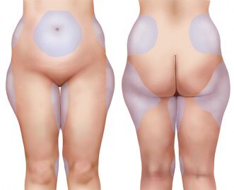 DrAshishDutta's tweet photo. #MicroLiposuction is a recently developed technique which allows #Surgeons to perform more #DelicateProcedures on the neck, face and #Sensitive areas of the skin.
https://t.co/VwGtjiKdrX https://t.co/kaInDHe00k