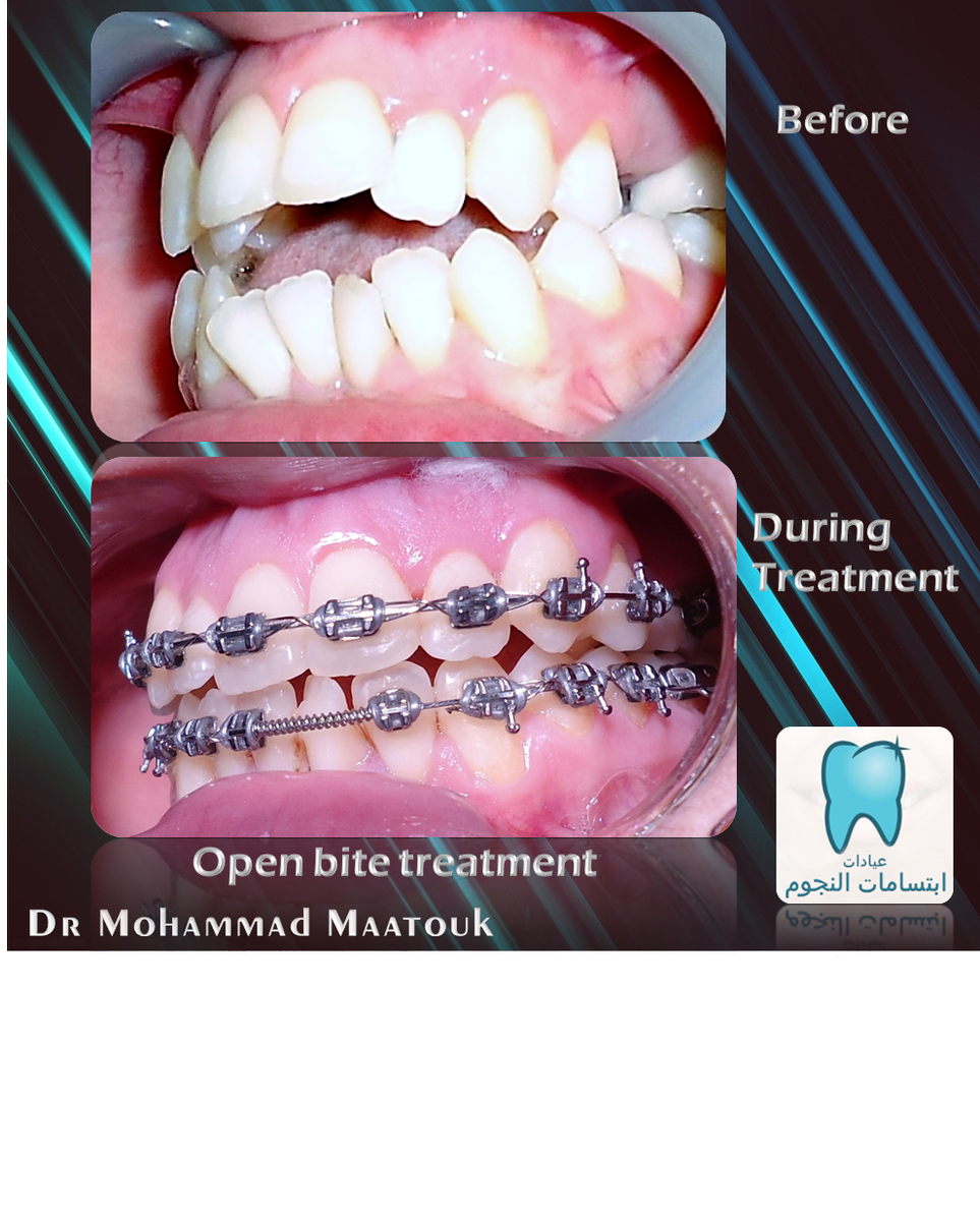 DrMaatouk's tweet photo. #smile #toothbrush #تقويم_الأسنان #جدة #دمحمد_معتوق #aligner #pure #lingual_braces #damon #damon_clear #eon_aligner #brushing https://t.co/n0e367ko1a