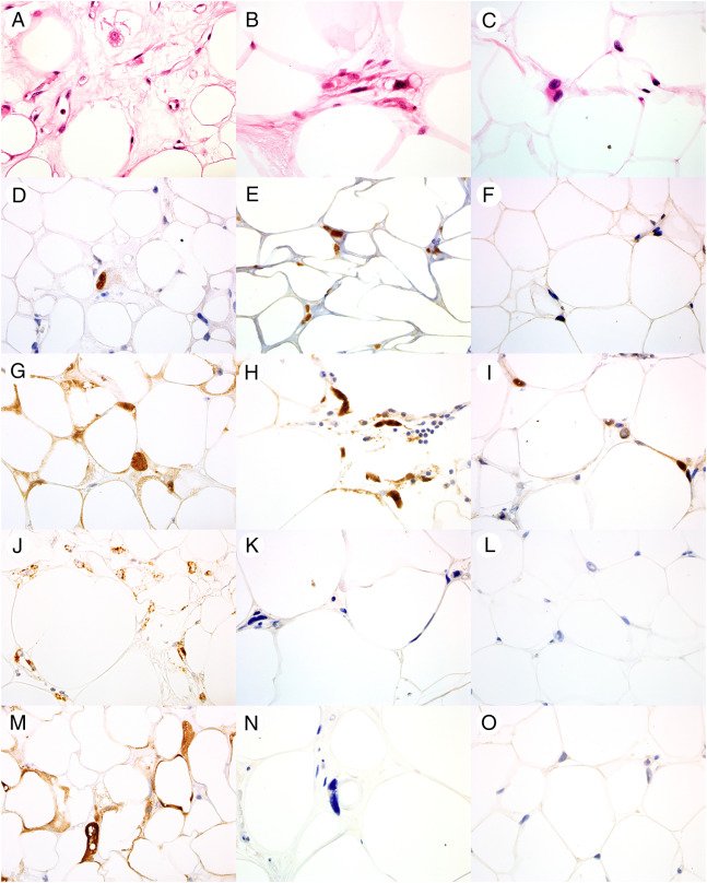 PathologyTweet's tweet image. Expression of MDM2 and p16 in Angiomyolipoma ow.ly/UF6o30ineD4  via @Human_Pathology #FNApath #RenalPath