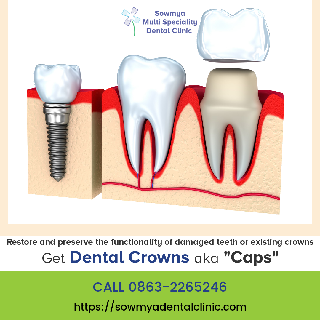 sowmyadental's tweet image. Restore and preserve the functionality of damaged teeth or existing crowns. visit goo.gl/7a1n9B

#dentalcaps #teethcaps #dentalcrowns #crowns #dentist #damagedteeth #brokenteeth #crackedteeth #dentalclinic #clinic #hospital #teethreplacement #fix #teeth #guntur #dental