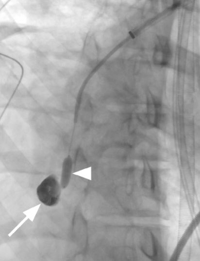 medravi's tweet photo. Balloon occluded onyx embo of a pulmonary artery mycotic aneurysm! #glueit #IRad #withoutascalpel @iRadRaj @CHICKVIR @AlexCVIR @Penn_IR @MountSinaiIR @_backtable @JMichaelBarraza @ABrandisVIR @Watts_IR @JVIRmedia @CVIR_Journal @SIRRFS @socpedsir https://t.co/MqiUK6GCq7