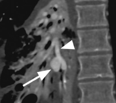 medravi's tweet photo. Balloon occluded onyx embo of a pulmonary artery mycotic aneurysm! #glueit #IRad #withoutascalpel @iRadRaj @CHICKVIR @AlexCVIR @Penn_IR @MountSinaiIR @_backtable @JMichaelBarraza @ABrandisVIR @Watts_IR @JVIRmedia @CVIR_Journal @SIRRFS @socpedsir https://t.co/MqiUK6GCq7