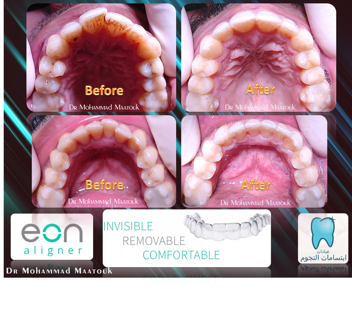 DrMaatouk's tweet photo. #smile #toothbrush #تقويم_الأسنان #جدة #دمحمد_معتوق #aligner #pure #lingual_braces #damon #damon_clear #eon_aligner #brushing https://t.co/r1xHUDlnwv