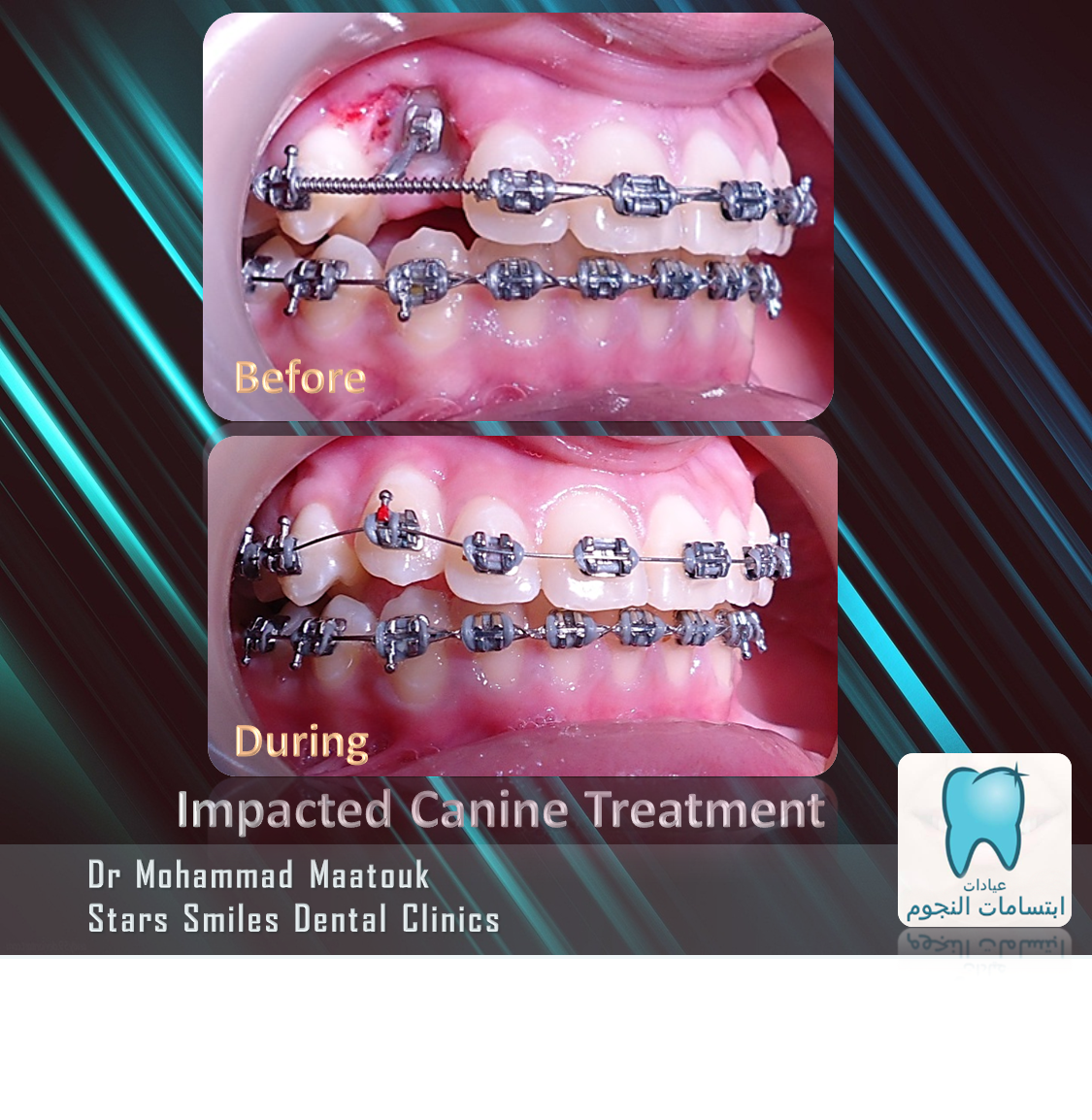 DrMaatouk's tweet photo. #smile #toothbrush #تقويم_الأسنان #جدة #دمحمد_معتوق #aligner #pure #lingual_braces #damon #damon_clear #eon_aligner #brushing https://t.co/tuzYjWTVFW