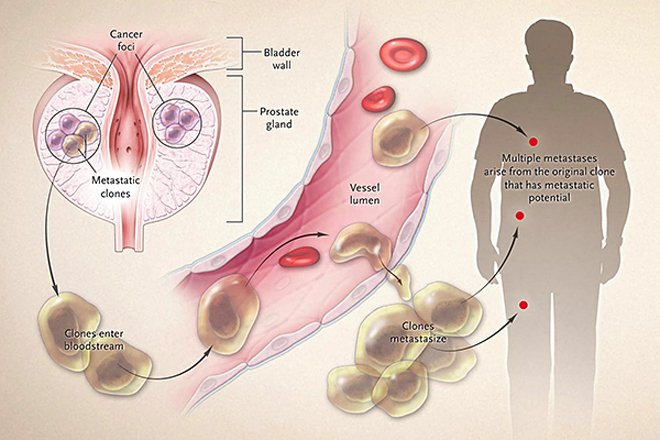 Carcinoma Of The Anal Canal