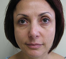 drnathannewman's tweet photo. Before and after 4 years the #StemCellLift. The Stem Cell Facelift restores the full face in one treatment, temples, cheeks, eye area, mouth area, neck and jowls, all in one procedure! Minimal downtime. Call us today to book your consultation or get more information! 310-273-3344 https://t.co/AFjzZbeeat