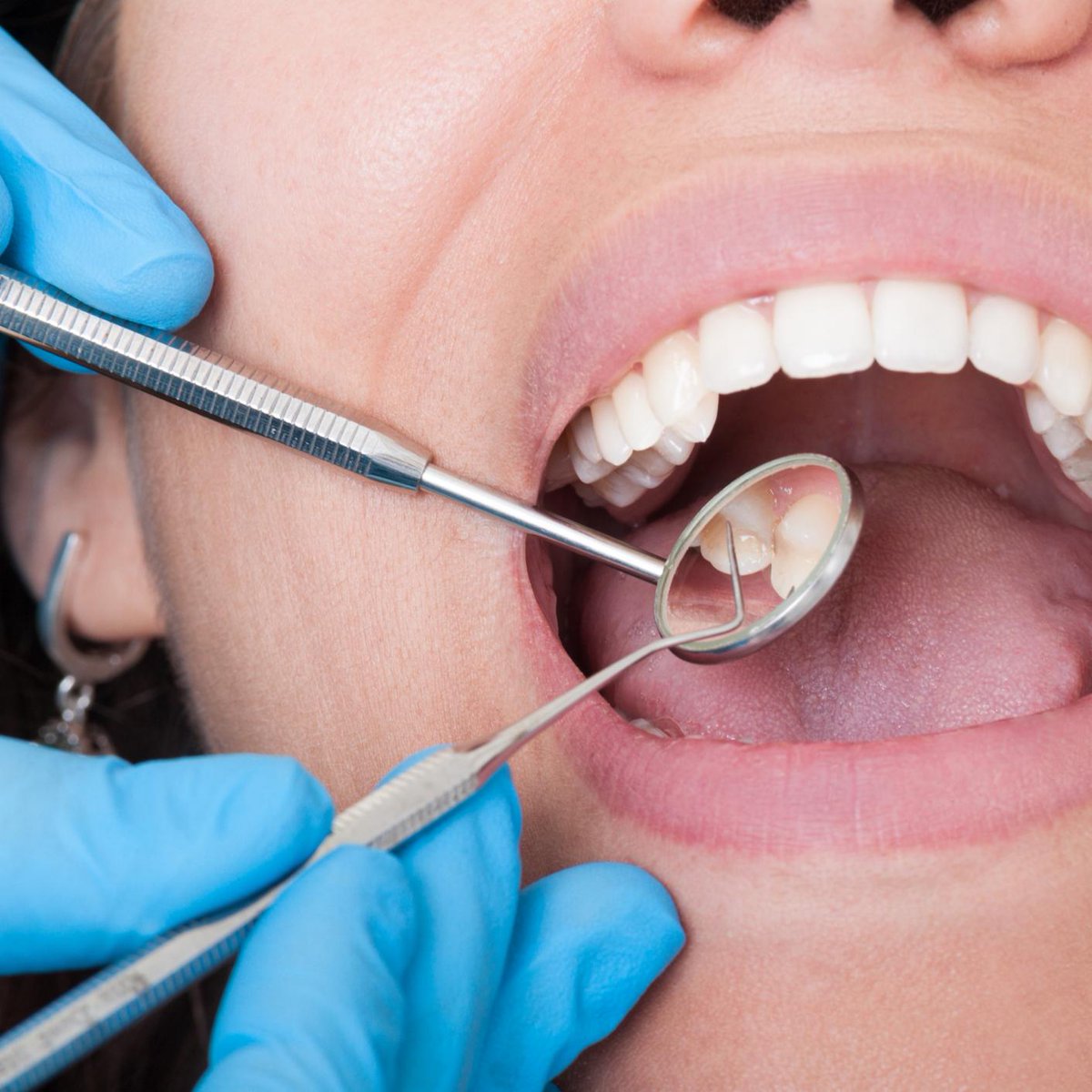 VDCDubai's tweet photo. Time is running out for you to get your #whitesmile at a discounted price. Contact us today to set up an appointment. https://t.co/pSs4yIJBZd https://t.co/ZWDwfwaTZR