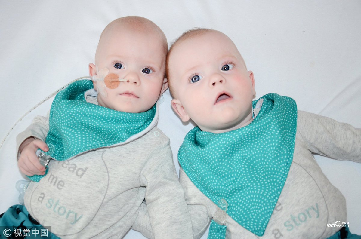 Cctv 英國雙胞胎艱難 共生 創造奇跡 來自英國的amie幸運的懷上一對雙胞胎blair和ellis 但是醫生告訴amie和她的丈夫paul 由於其中一個個頭太小 應該終止其妊娠 幫助個頭大的寶寶更好發育 幸運的是 兄弟倆艱難的 共生 下來 創造了奇跡 T