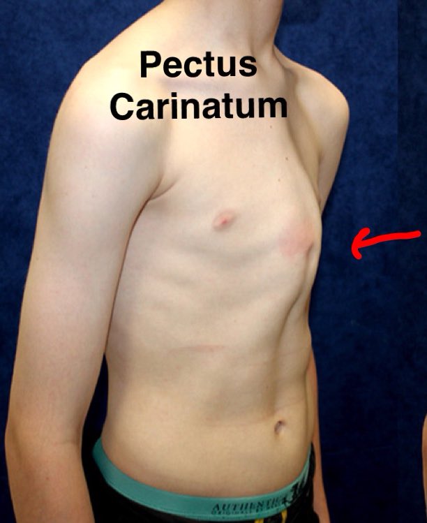 Protruding Chest Bone