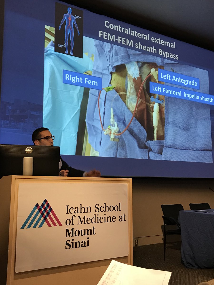 chadialraies's tweet image. Contralateral external fem-fem #bypass for occlusive sheath #PercAx #ACCIC
