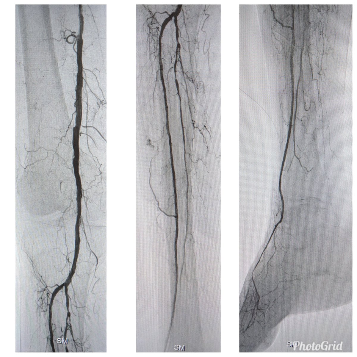 SOBE_Vascular's tweet image. 90 y/o F with rest pain, poor op candidate. #CLI #dojustenough #commandwire @abbottvascular @AbbottGlobal #CSI #DCB @BardPV #vesselprepcrucial #nometalleftbehind #stopthechop #CLIfighters #clifighters @DrBTKatzen @SriniTummala @Mustapja @FadiSaab17 @Heartpower717 @drsavealimb