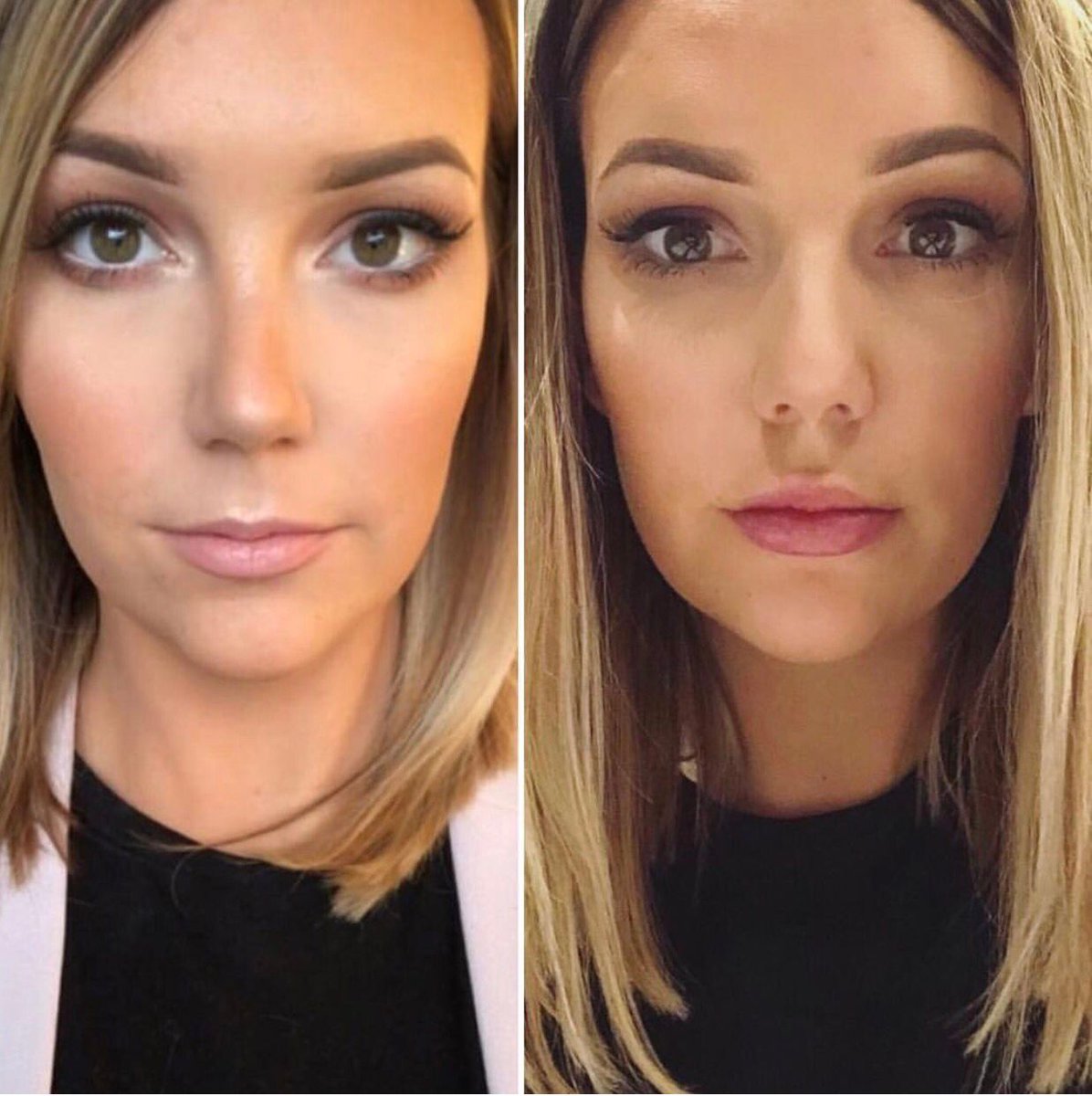 This stunning result by Tallulah at buff.ly/2EongAB is with just 1ml of #dermalrevolutoiom DERM / #aesthetics #dermalfillers #filler #lipfiller