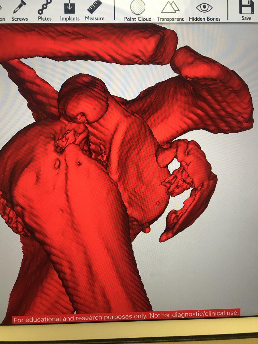 Richard Hurley (@richardhurleymd) on Twitter photo Setting up a shoulder fracture dislocation #3Dprint “very easy” <a href="/DGHfoundation/">Dartmouth General Hospital Foundation</a> #3Dprinting #anatomicalmodels for #surgicalplanning in-hospital using an iPad <a href="/Conceptualiz_/">Conceptualiz</a> #Ossa3D #iPad2Print #medical3Dprinting <a href="/makerbot/">MakerBot</a> will be ready overnight. Setting up a shoulder fracture dislocation #3Dprint “very easy” <a href="/DGHfoundation/">Dartmouth General Hospital Foundation</a> #3Dprinting #anatomicalmodels for #surgicalplanning in-hospital using an iPad <a href="/Conceptualiz_/">Conceptualiz</a> #Ossa3D #iPad2Print #medical3Dprinting <a href="/makerbot/">MakerBot</a> will be ready overnight.
