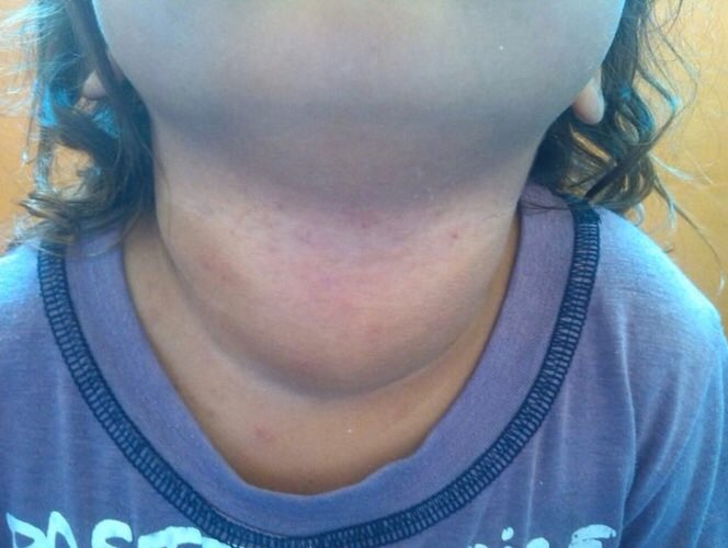 Marcoslimamd's tweet photo. La existencia de más de 600 casos de aumento de tamaño de la glándula tiroides (Bocio) principalmente en niños del Estado Portuguesa es algo alarmante y podría reflejar un retroceso de más de 50 años cuando había deficiencia de yodo en las regiones montañosas de Venezuela. https://t.co/zeyo3Y7IF2