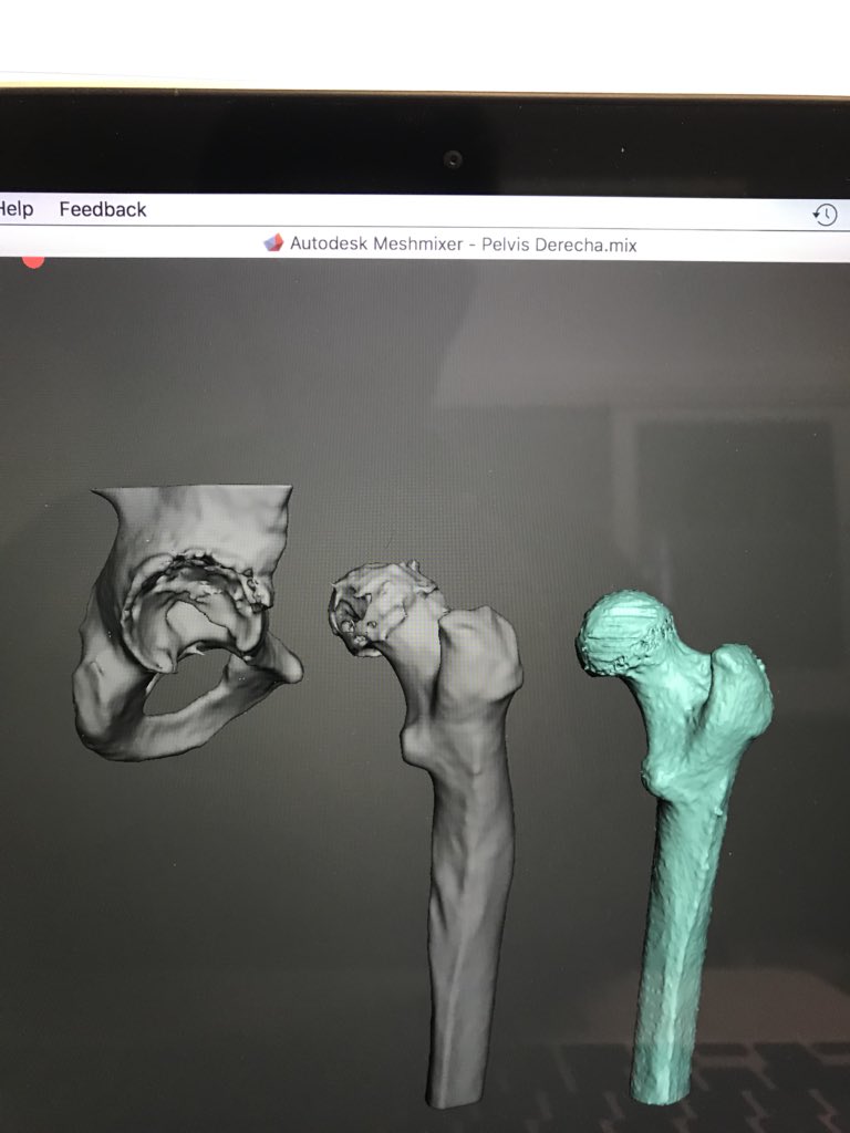 CharlieMonitor's tweet photo. Cost effective 3D printing of a pathologic right hip and femur with a healthy mirrored left femur for reference for pre assessment and aid during surgery at Hospital @3d_maranon. @rupermac @calvoharo_ja @BiomedAdrian @3DGabBME @BiomedEstefania https://t.co/eQkwBy9w8N