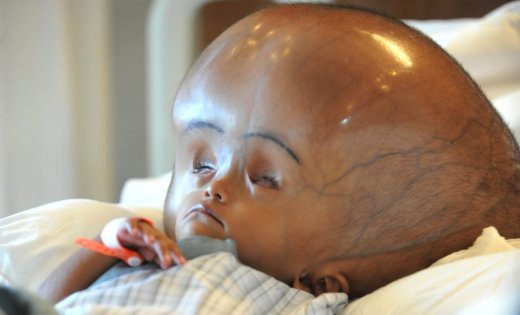 Firingoti's tweet image. Do not panic if you notice Hydrocephalus (excessive buildup of cerebrospinal fluid in skull and brain) symptom in your child. Visit nearest medical centre to know more and seek doctor’s advice.
#hydrocephallus #assamissue #firingotiinitiative