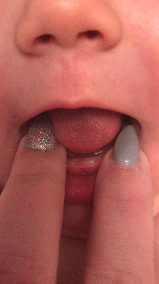 KirstR92's tweet photo. We have a very small second tooth, explains her mood the last few days π #babyteeth #teething #2teeth https://t.co/CWijArWxFJ
