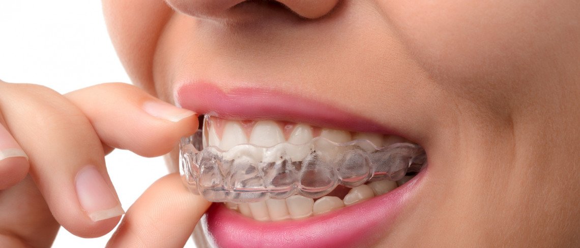 comparethetreat's tweet photo. Comparethetreatment’s Guide to Invisible Braces: https://t.co/8GtqcfVIjM #InvisableBraces #Allyouneedtoknow https://t.co/MLgMs3L4tf