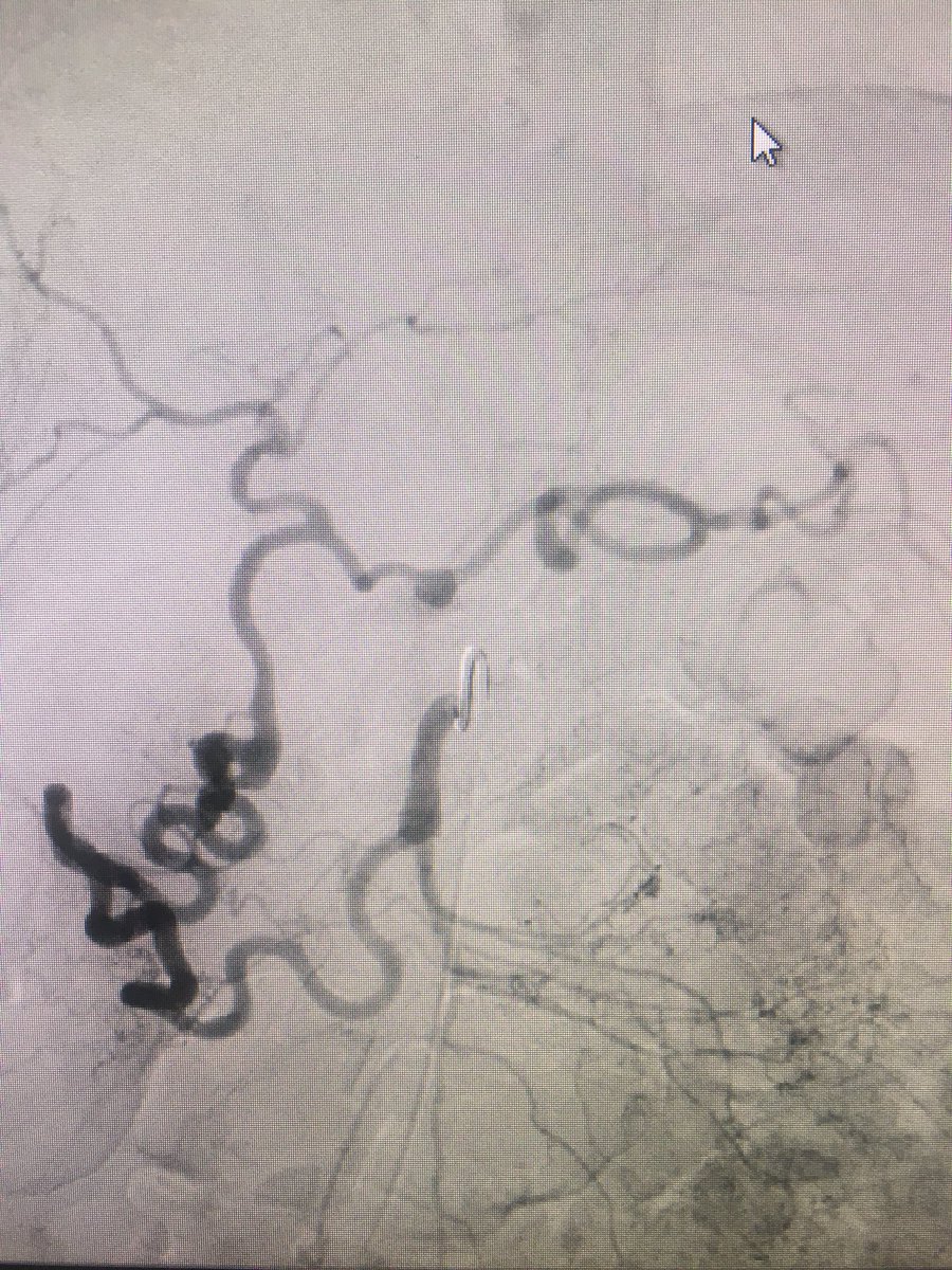 kristenwelchh's tweet photo. Immediately upon teaching your intern about mesenteric collateral pathways and the PD Arcade.. 😳#iRad #textbookcase @AVIRnews @mikekellyAVIR https://t.co/P304NxTA5r
