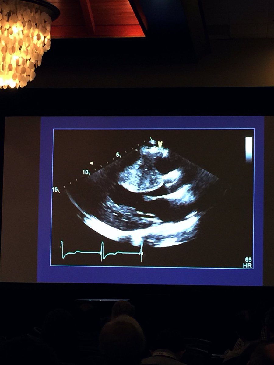 echogenics's tweet photo. @ASE360 a very interesting and informative talk on variants of Hypertrophic Cardiomyopathy by Matt Umland #ASE #ASE360 #EchoSOTA #SanDiego #Echogenics https://t.co/Kn6kn8bFkM
