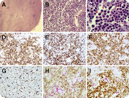 feldstej's tweet photo. #CMMOL #Mature PCD proliferation #heme #hemepath https://t.co/cSPi8N25Bg https://t.co/OrzjS8HCW2
