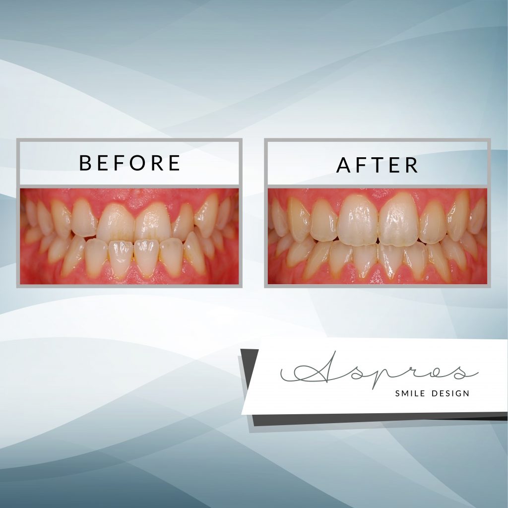 DimosKouyiounta's tweet image. FASTBRACES® - H νέα ανώδυνη ορθοδοντική - i-eidisi.com/2018/02/20/fas…