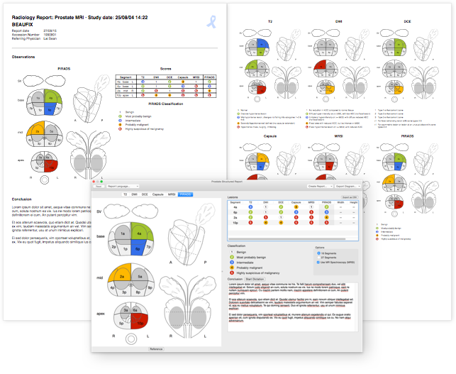 OsiriXViewer's tweet photo. PIRADS and other Structured Reports are available in OsiriX since more than 2 years! OsiriX makes life easier for radiologists year after year! #OsiriXMD #theBest #DICOM #viewer #MedicalDevices #Radiology #PIRADS #BIRADS #DICOMSR #StructuredReports https://t.co/eZN89GQqXe