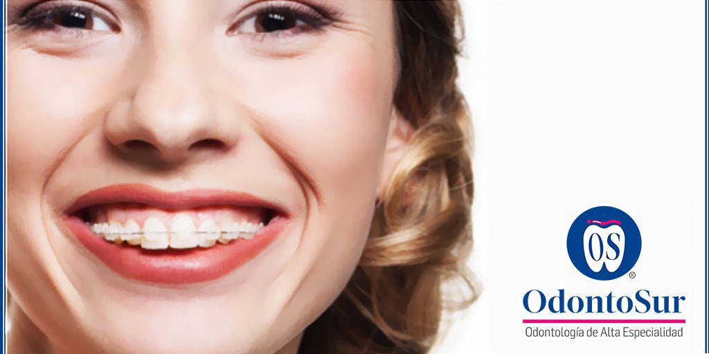 odontosur's tweet photo. El Cristal de #Zafiro es un elemento conocido por su dureza y transparencia lo que hace el material ideal para #BRACKETS #ESTÉTICOS. #ortodoncia #FelizViernes #odontosur #sonrisa #dentistavillahermosa #esteticadental #beneficiosortodoncia https://t.co/qHgO96KjAg