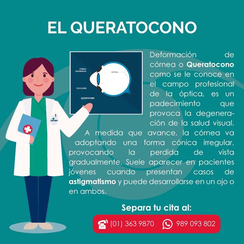 La deformación de la córnea o #Queratocono, es un padecimiento que provoca la degeneración de la vista debido a que la córnea va adoptando una forma cónica irregular. Suele presentarse en jóvenes con astigmatismo pero puede manifestarse a cualquier edad. #OftalmoVissum