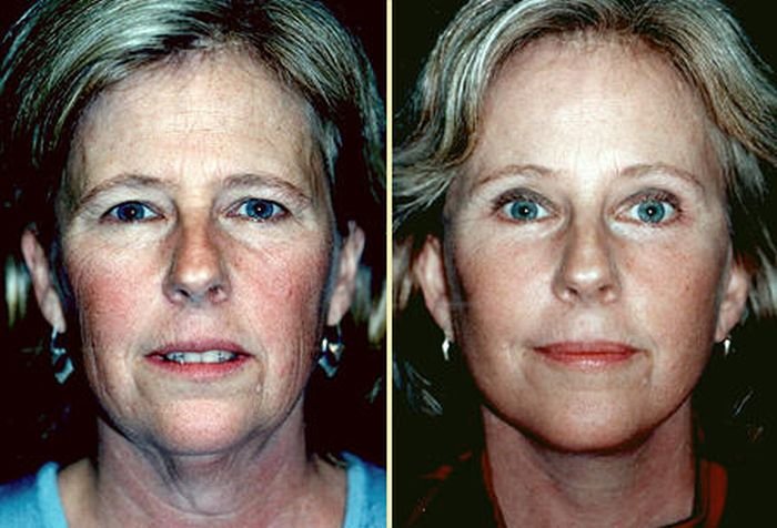 Natural Facelifts Elements Utilizing Face Workouts And Reflexology Techniques To Look Years More Youthful goo.gl/lWDvf