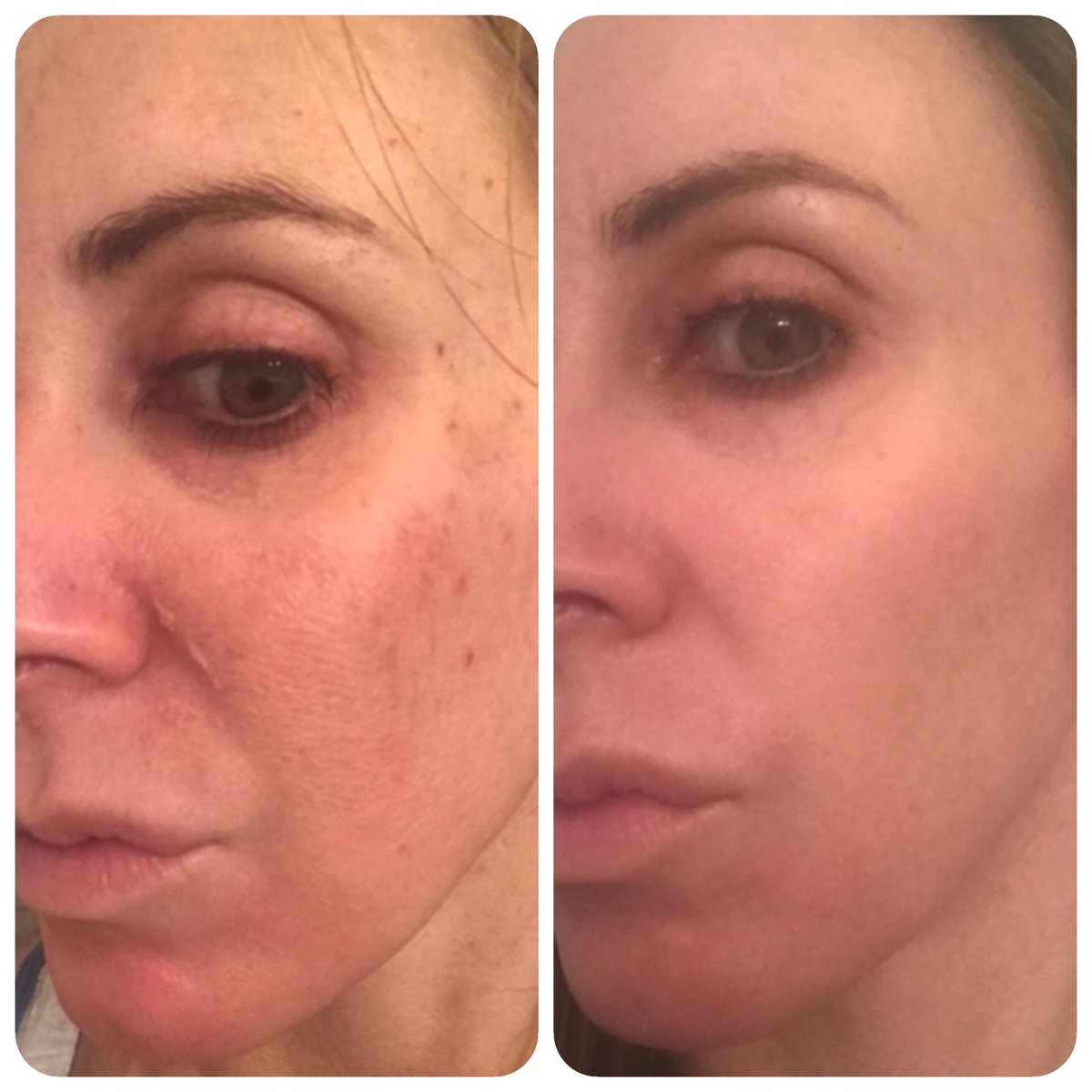 ThePerfectDerma's tweet image. Transformation Tuesday!

Check out these Before &amp;amp; Afters  (1 peel treatment)