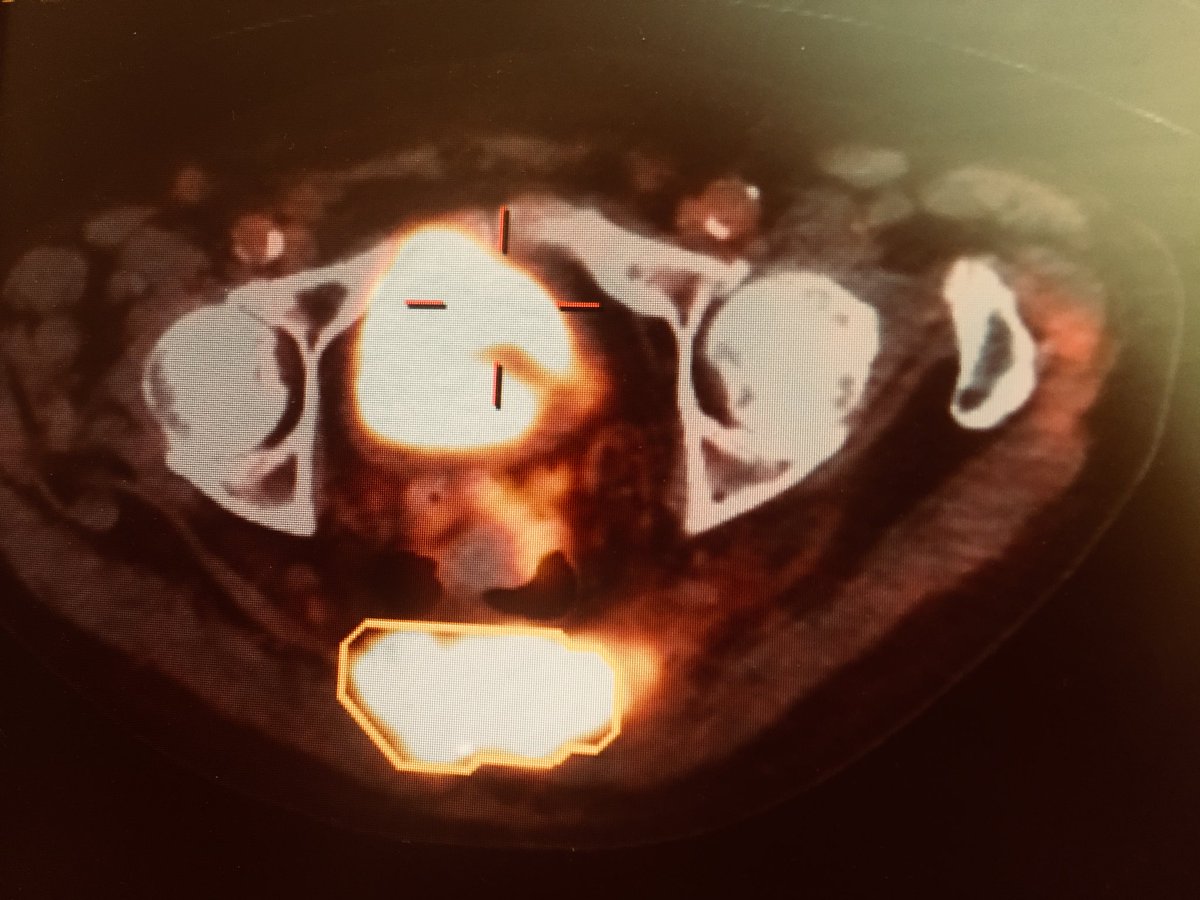 rupermac's tweet photo. Surgical 3D planning of a case of high-grade primary #sarcoma of the sacrum. Using the patient's PET-CT, we #3dprinted in our hospital #FabLab @3d_maranon the #biomodel with two-color PLA @sarcomapatients @myESMO @_SEOM @GrupoGeis #HospitalGregorioMarañon @calvoharo_ja https://t.co/f05X5mzoFi