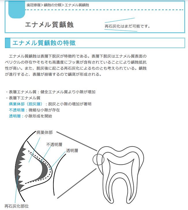 エナメル質齲蝕