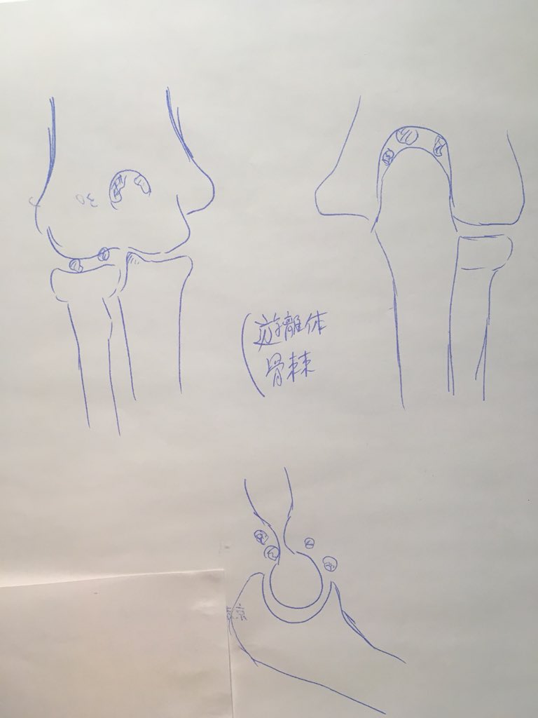 コリバド 本日 京都九条病院で右肘関節内遊離体 関節ねずみ と右変形性肘関節症 骨のささくれ の内視鏡手術をします 9 45入室です バドミントンのやり過ぎ 抜糸予定は2 28です