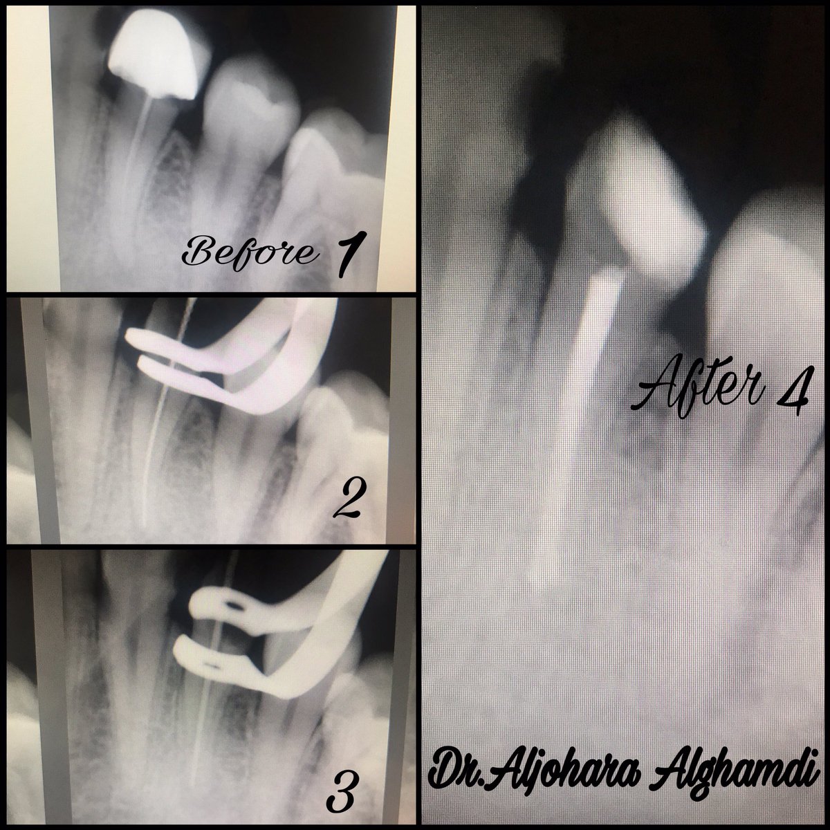 AljoharahKhalid's tweet photo. Retreatment for tooth #34 ..
شغل اليوم ✋🏼💙
#rcdp
#rcsdp
#REU https://t.co/h8stxJzoMW