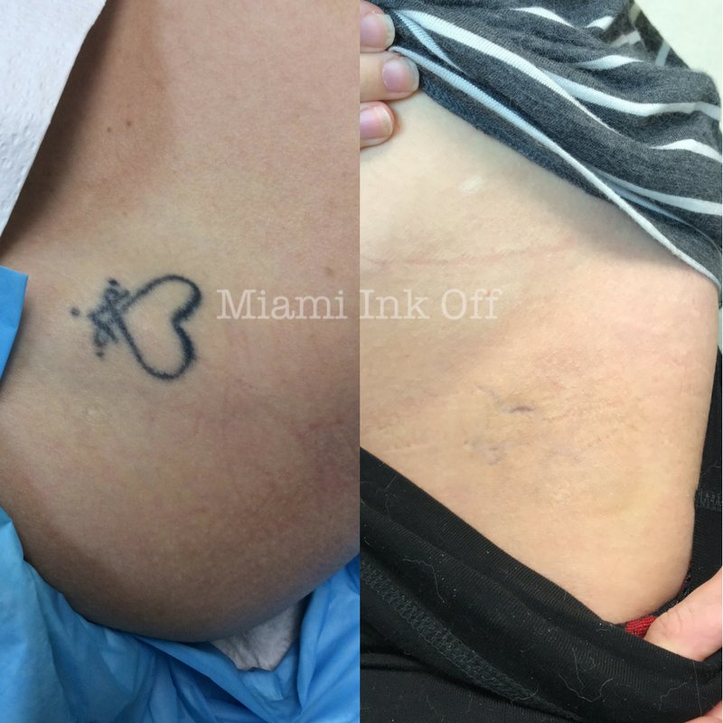 Miami Center for Cosmetic Dermatology  Dr Deborah Longwill Laser Tattoo  Removal System  Miami Center for Dermatology