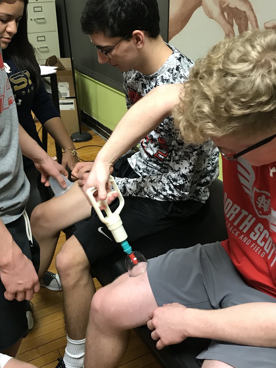 BeckyEdmundson2's tweet photo. Cupping in action..Health 2 students #ITMW @NSHSActivities https://t.co/M6V0WudxNq